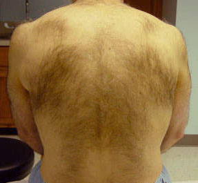 laser hair removal before nyc